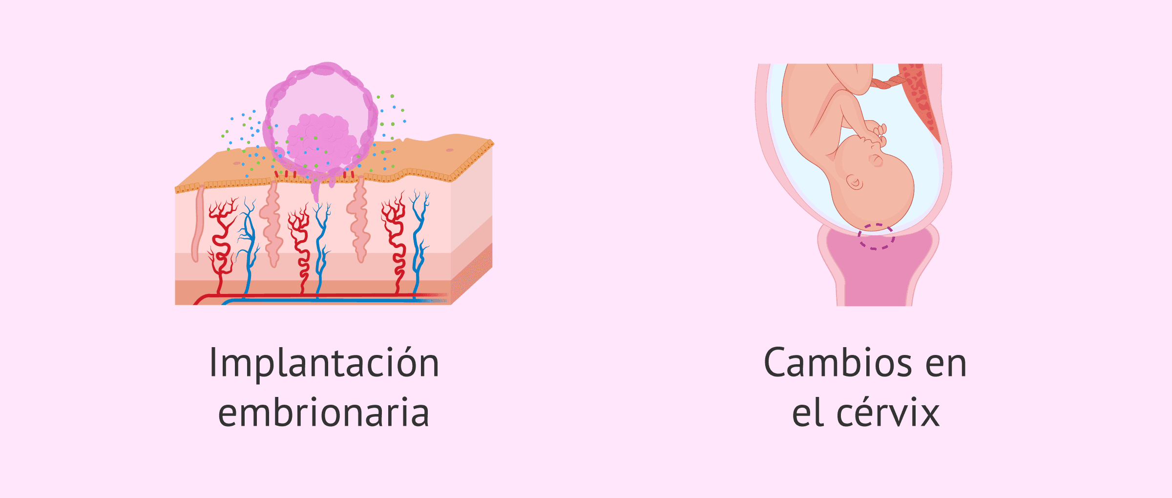 Causas De Las Hemorragias Deciduales En El Embarazo