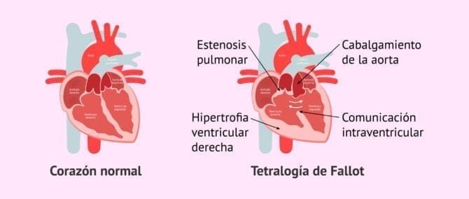 Tetralogía de Fallot y embarazo