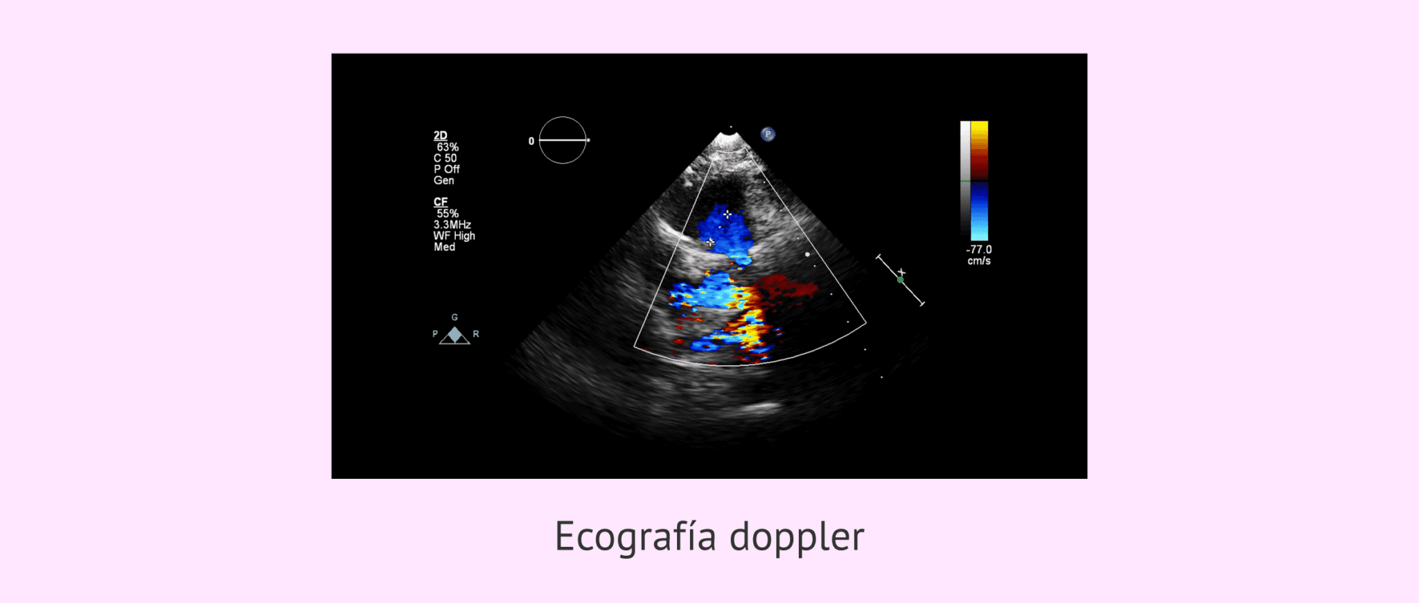 Qu Es Una Ecograf A Doppler