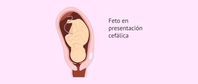 Qué es la presentación cefálica