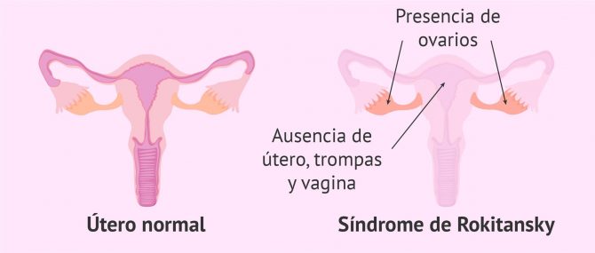 personas que nacen con órganos masculinos y femeninos