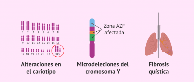 Imagen: Causas genéticas de azoospermia