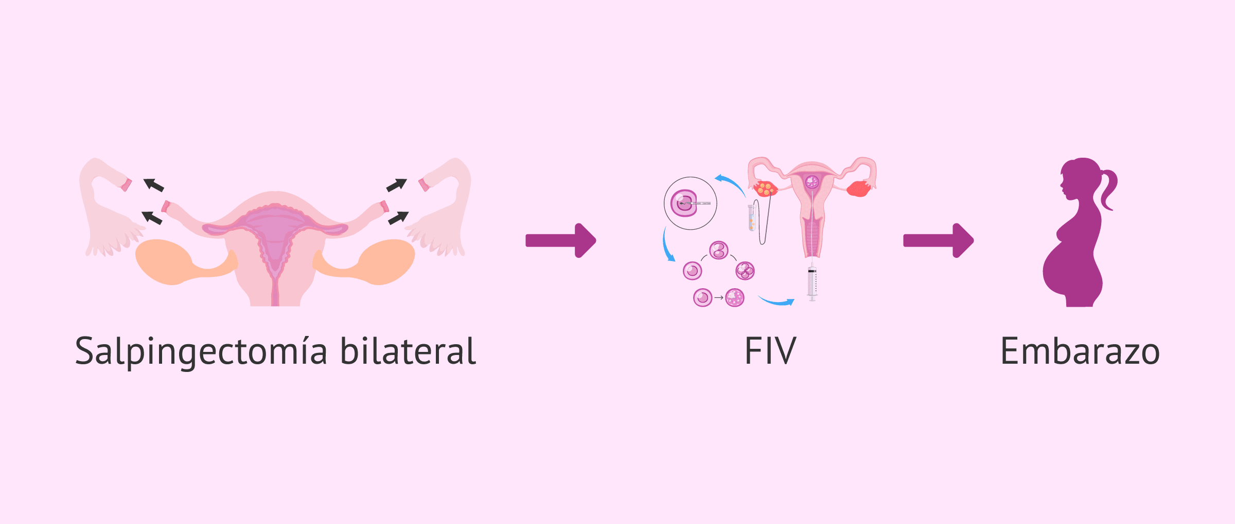 Imagen: Embarazo con salpingectomía bilateral