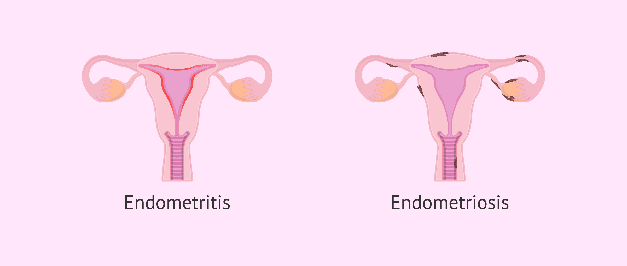 Imagen: Endometritis vs Endometriosis