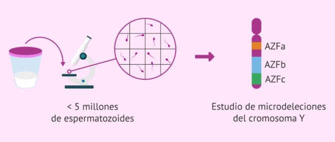 Imagen: Oligozoospermia y estudio de las microdeleciones del cromosoma Y