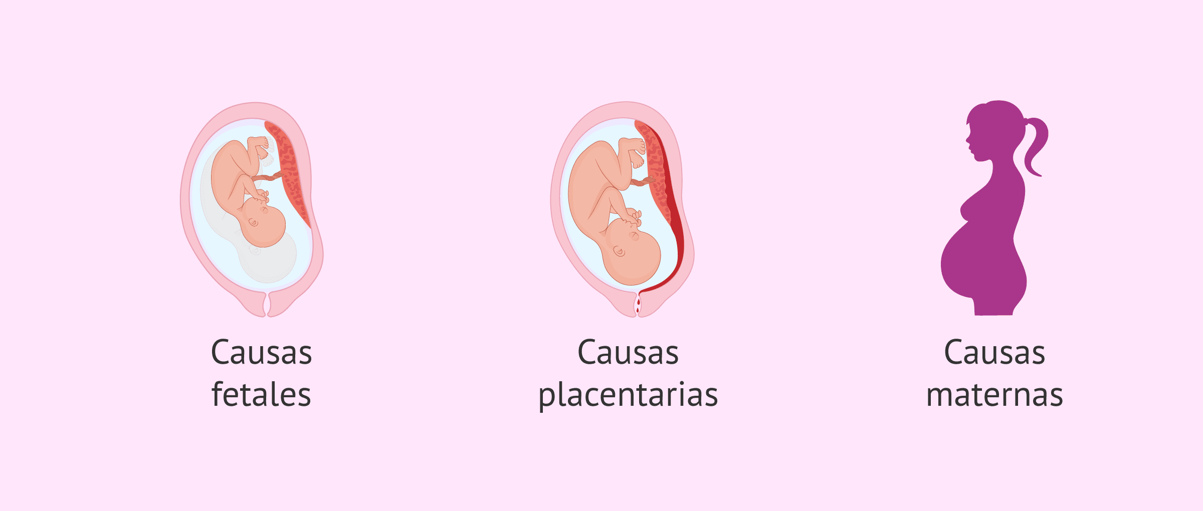 Imagen: Posibles causas de oligohidramnios