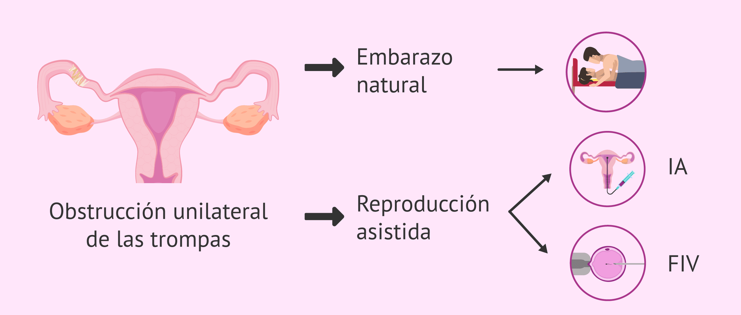 Embarazo con obstrucción tubárica unilateral