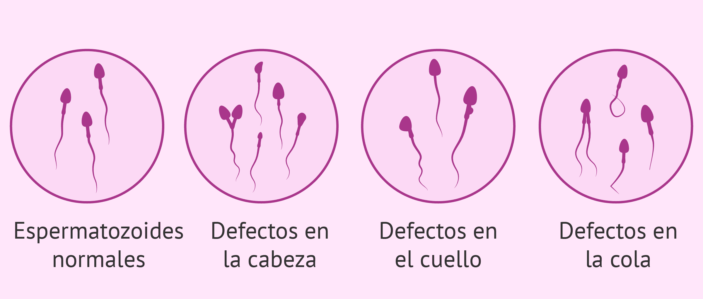 ¿qué Tipos De Deformaciones Espermáticas Existen