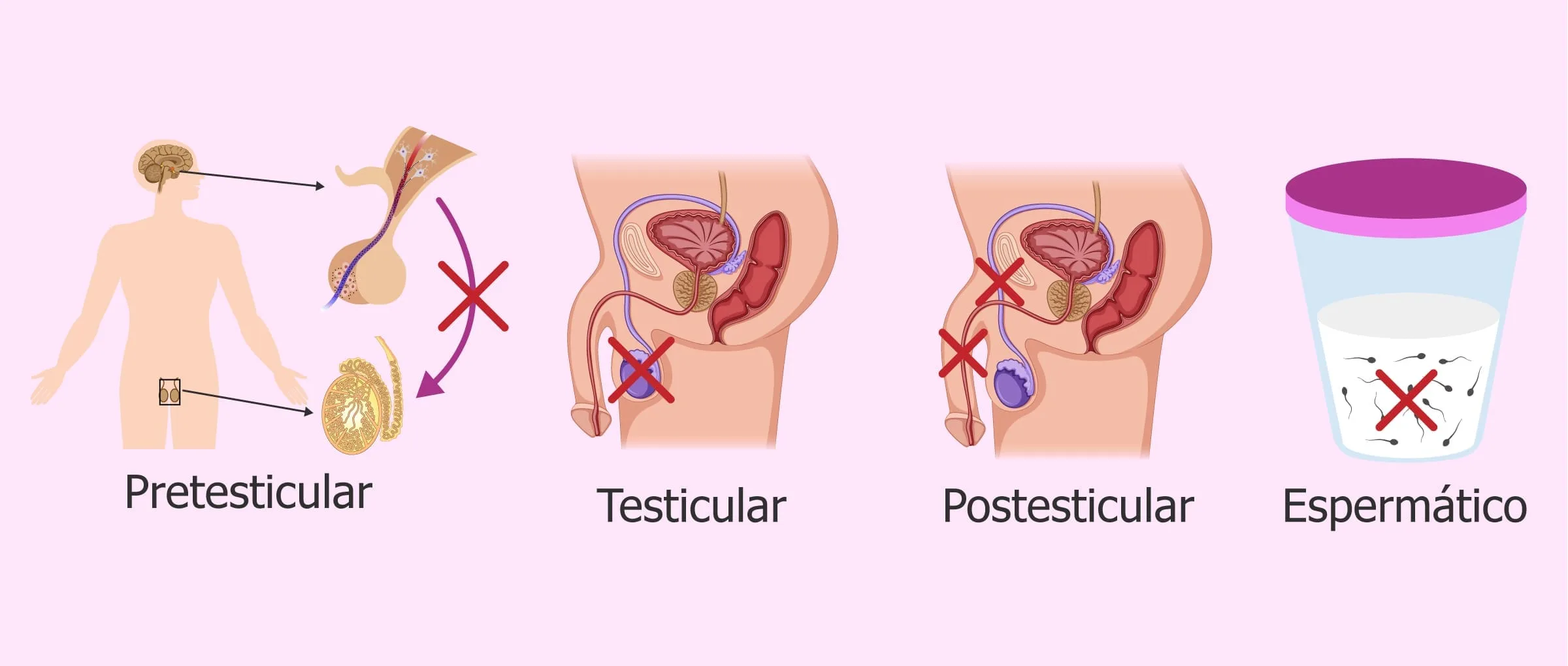 La esterilidad masculina