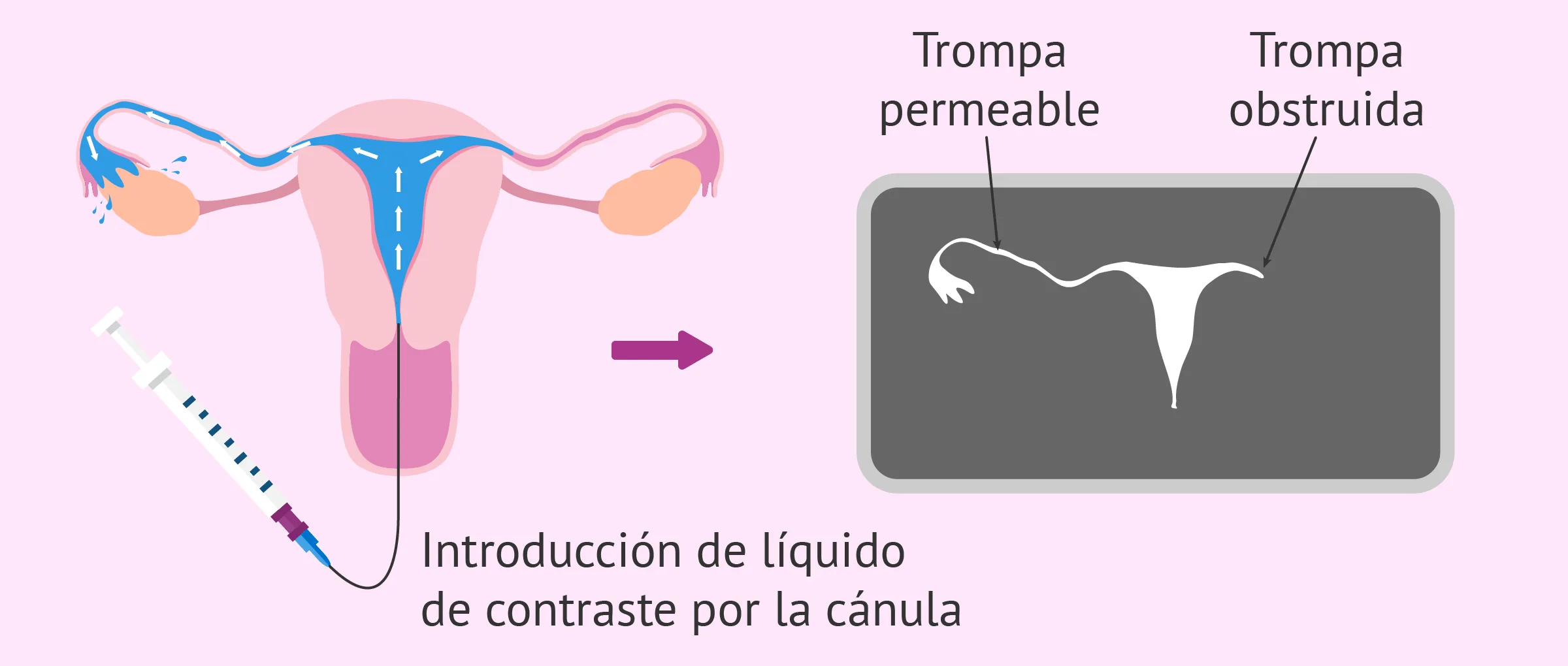 La histerosalpingografía