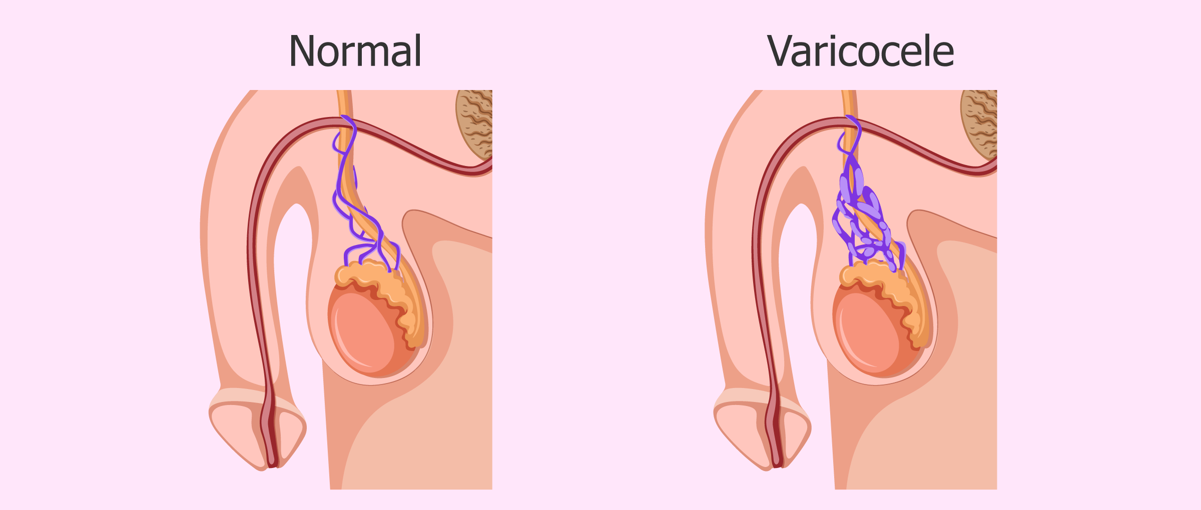 Se puede lograr el embarazo con varicocele testicular?