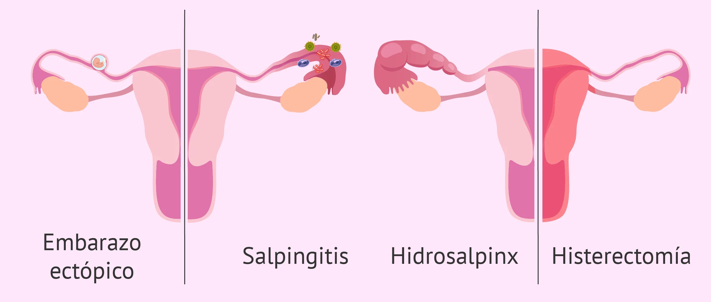 Indicaciones para hacer una salpingectomía