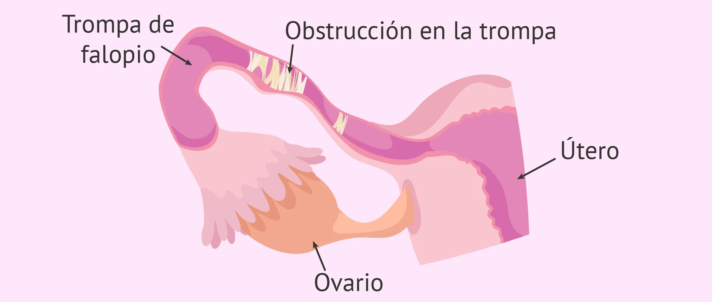 Trompas de Falopio obstruidas