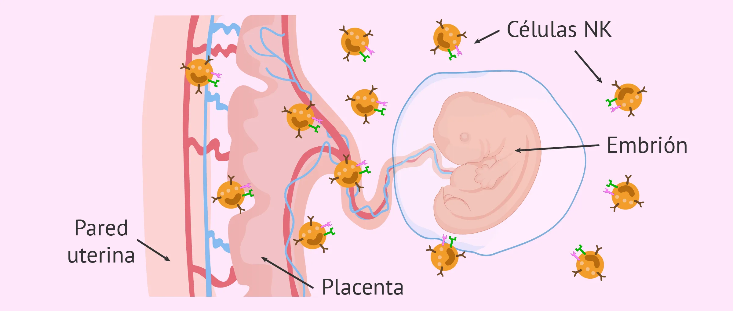 Linfocitos que atacan al embrión y causan aborto