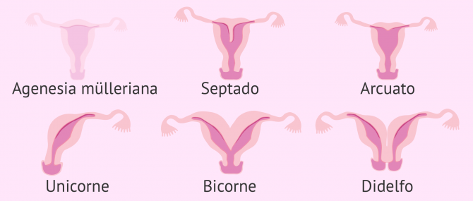 Imagen: Esterilidad en la mujer por problemas uterinos.