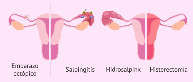 Imagen: Indicaciones para hacer una salpingectomía