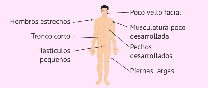 Imagen: Características físicas del síndrome de Klinefelter