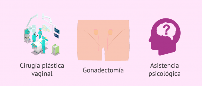 Imagen: Alargamiento de la vagina