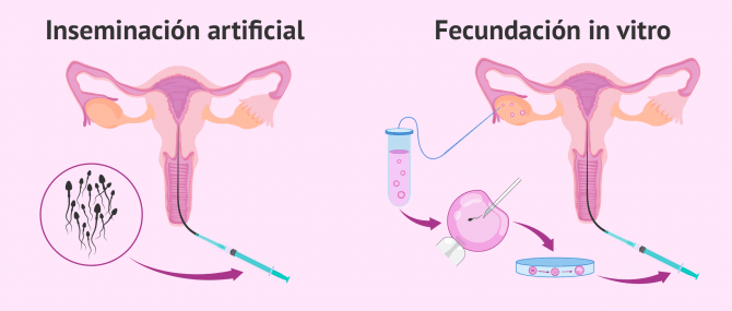 Imagen: Someterse a una inseminación