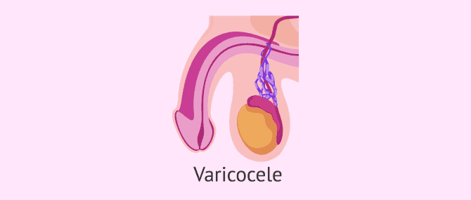 Imagen: El varicocele testicular