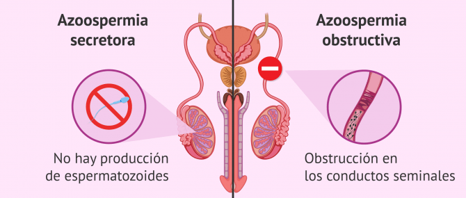 Imagen: Motivos para realizar una biopsia testicular