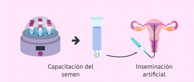 Imagen: Coito dirigido o inseminación