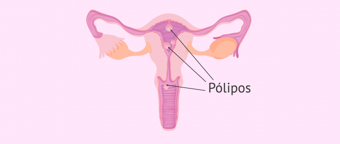 Imagen: Pólipo uterino