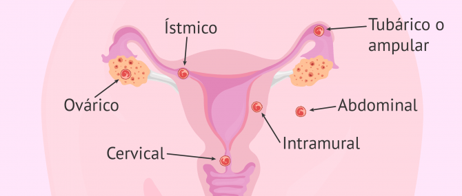 Imagen: Posibles localizaciones del embrión en embarazo ectópico