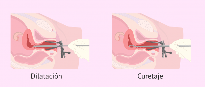 Imagen: Dilatación y curetaje de un legrado uterino