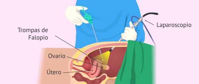 Imagen: Salpingectomía, esterilización femenina.