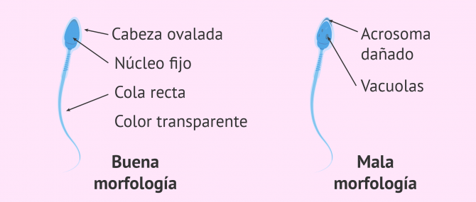 Imagen: Selección del mejor espermatozoide con IMSI