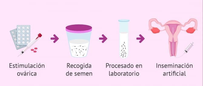 Imagen: Inseminación homóloga