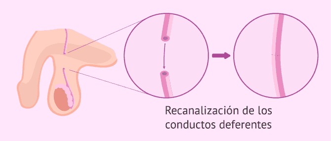 Imagen: Ausencia de espermatozoides en la vasectomía