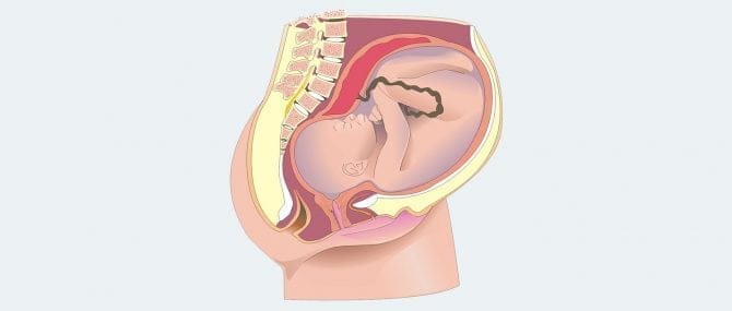 Imagen: Daños en la placenta