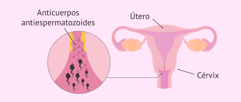 Imagen: Anticuerpos-antiespermatozoides en el moco cervical