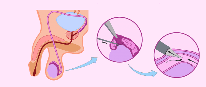 Imagen: Aspiración microquirúrgica de espermatozoides del epidídimo (MESA)