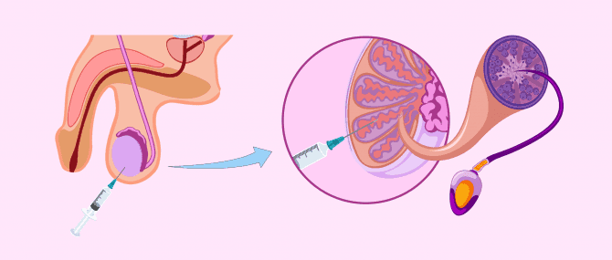 Imagen: Aspiración de espermatozoides del testículo