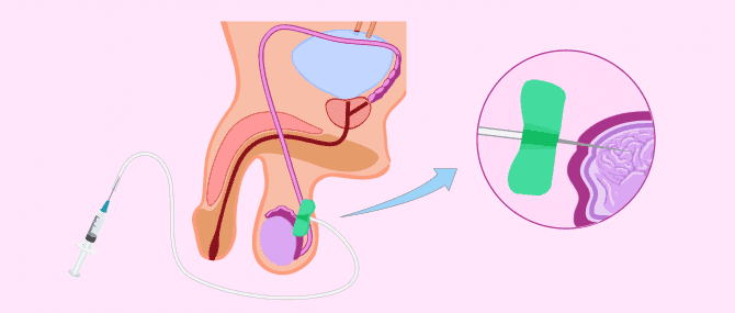 Imagen: Aspiración percutánea de espermatozoides de epidídimo (PESA)