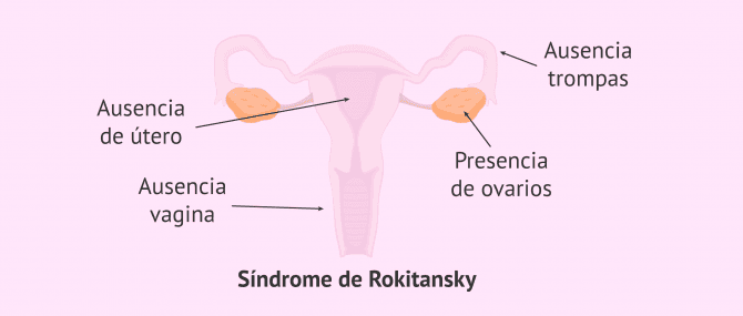 Imagen: ¿Qué es el Síndrome de Rokitansky?