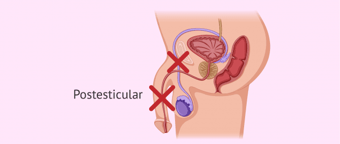 Imagen: Causa postesticular de azoospermia