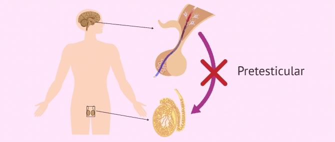 Imagen: Causa pretesticular de azoospermia