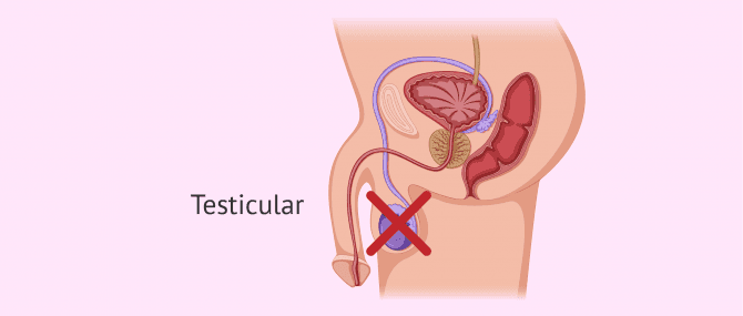 Imagen: Causas testiculares de azoospermia