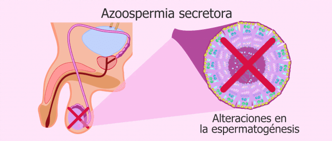 Imagen: Alteraciones que impiden la producción de espermatozoides