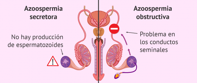 Imagen: Diferencias entre azoospermia obstructiva y secretora