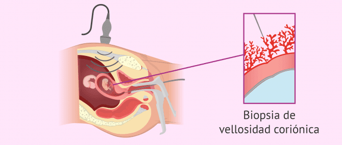 Imagen: Técnica de biopsia de corion