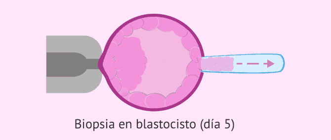 Imagen: Biopsia de blastocisto en día 5