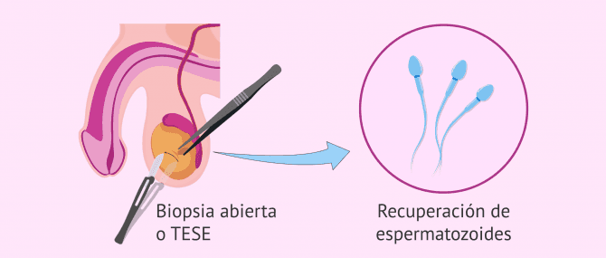 Imagen: Biopsia testicular abierta (TESE)