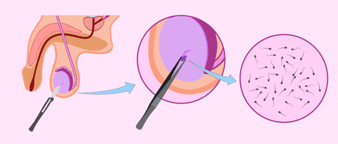 Imagen: Biopsia de testículo para casos de azoospermia