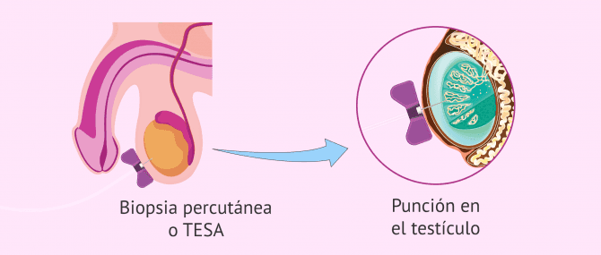 Imagen: Biospia percutánea testicular (TESA)