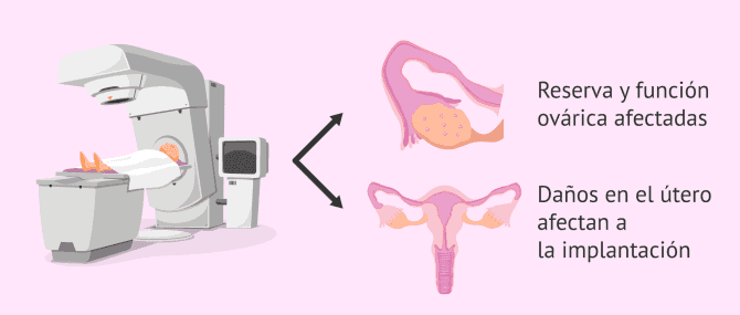 Imagen: Radioterapia e infertilidad femenina